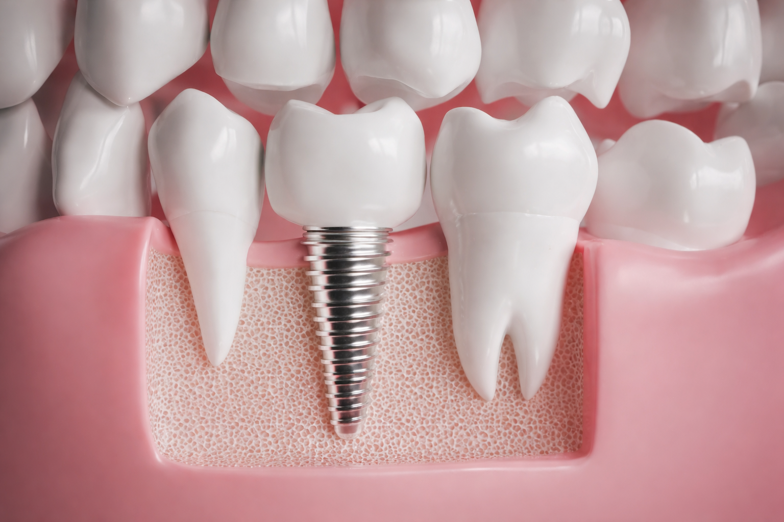 Pose d'implant dentaire - Cabinet Dr Bejjar Djerba