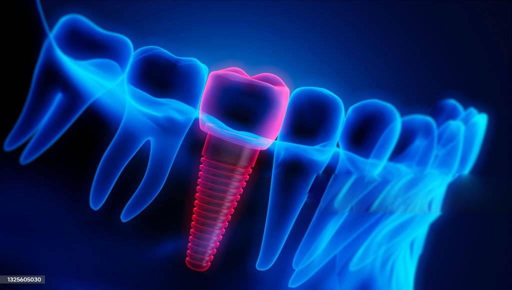 Pose d'implant dentaire - Cabinet Dr Bejjar Djerba